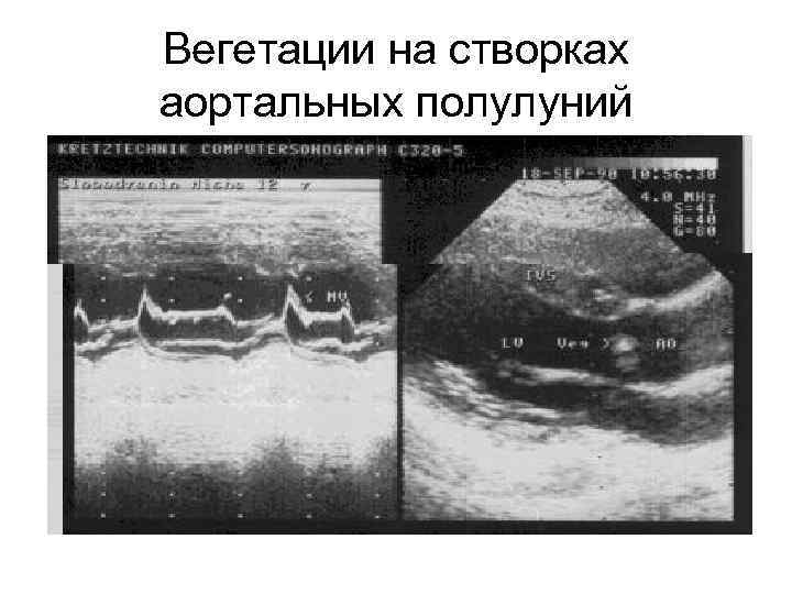 Вегетации на митральном клапане