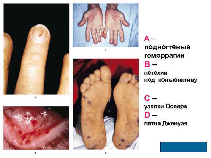 A – подногтевые геморрагии B – петехии под конъюнктиву C – узелки Ослера D