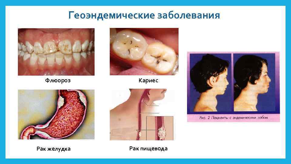 Геоэндемические заболевания Флюороз Рак желудка Кариес Рак пищевода 