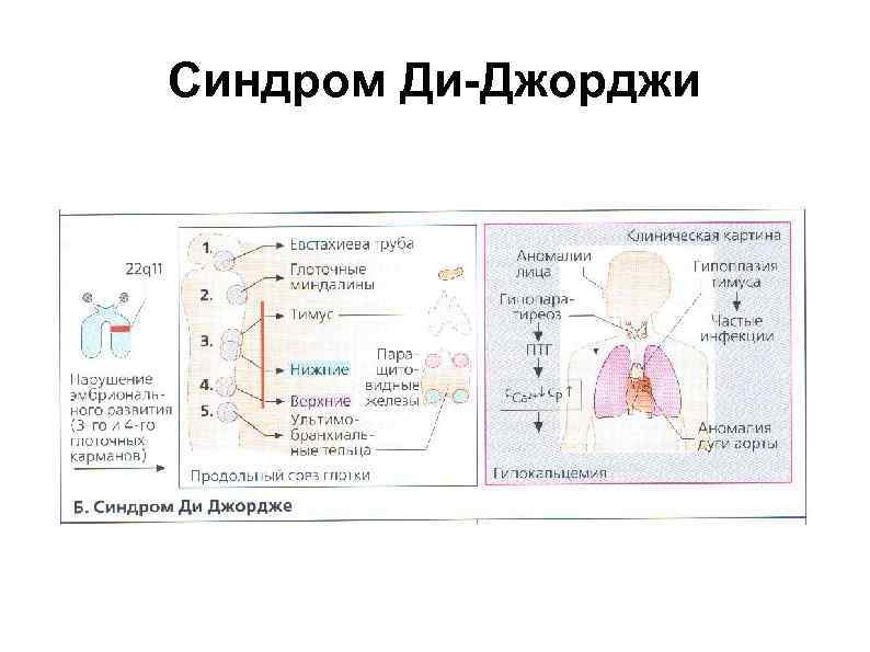 Синдром ди джорджи