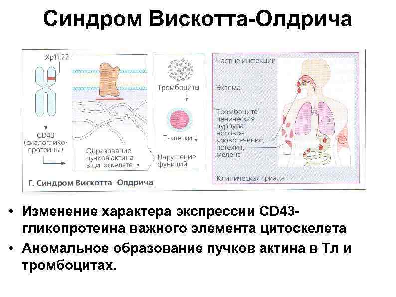 Синдром Вискотта-Олдрича • Изменение характера экспрессии CD 43 гликопротеина важного элемента цитоскелета • Аномальное