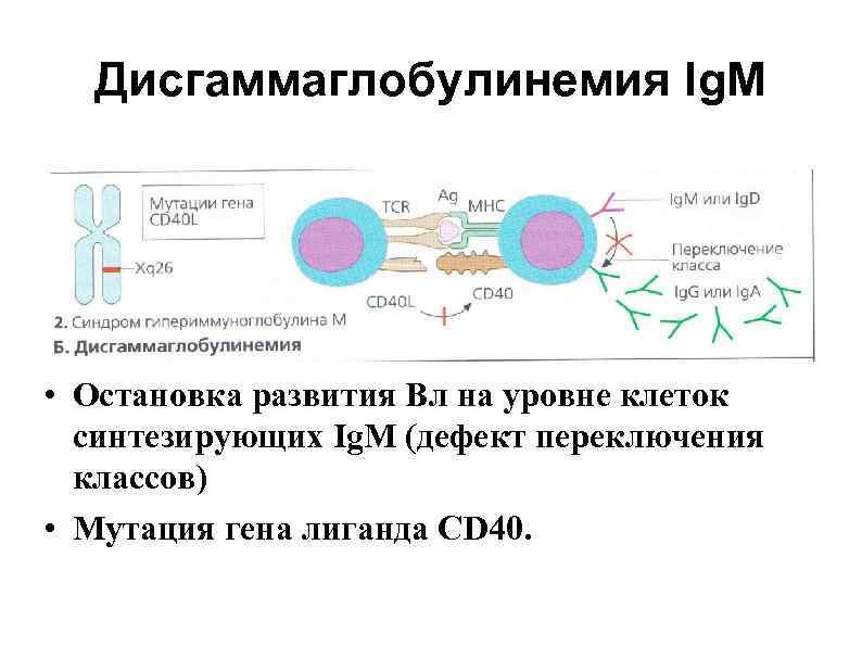 Дисгаммаглобулинемия Ig. M • Остановка развития Вл на уровне клеток синтезирующих Ig. M (дефект