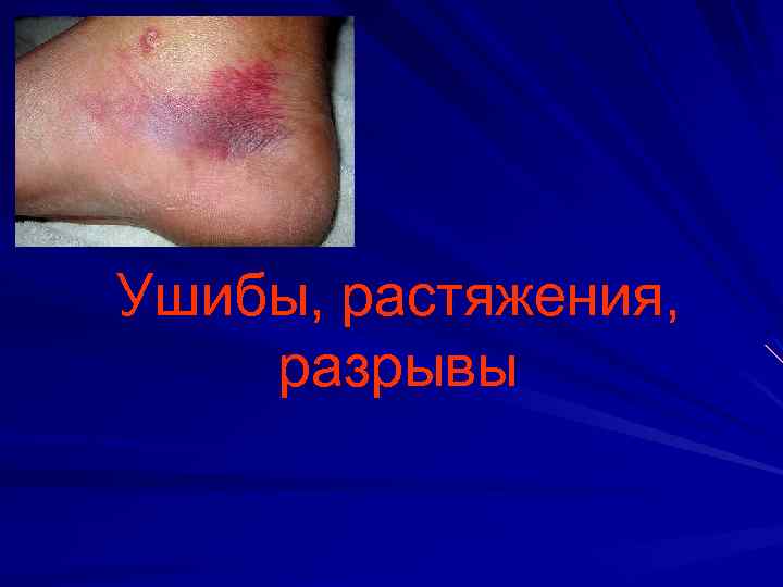 Ушибы, растяжения, разрывы 