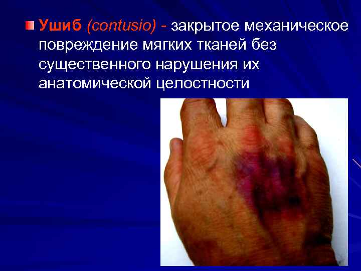 Ушиб (contusio) закрытое механическое повреждение мягких тканей без существенного нарушения их анатомической целостности 