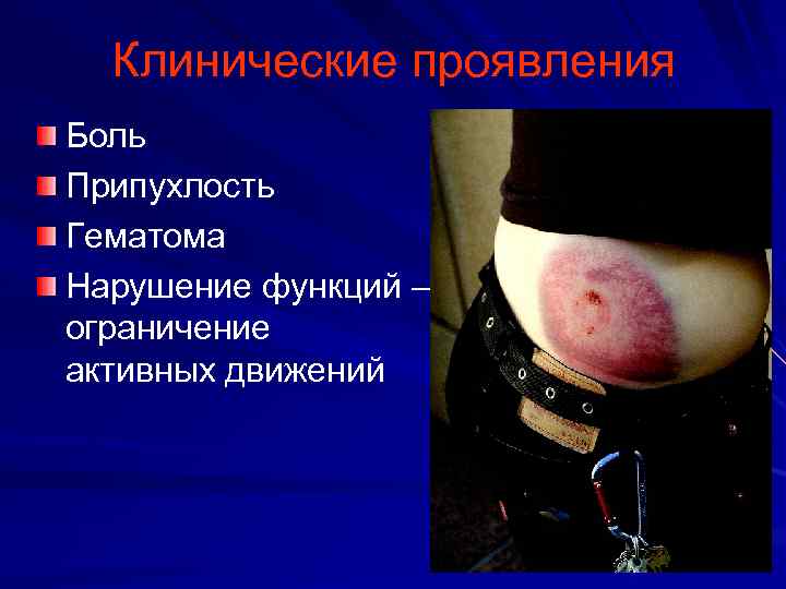 Клинические проявления Боль Припухлость Гематома Нарушение функций – ограничение активных движений 