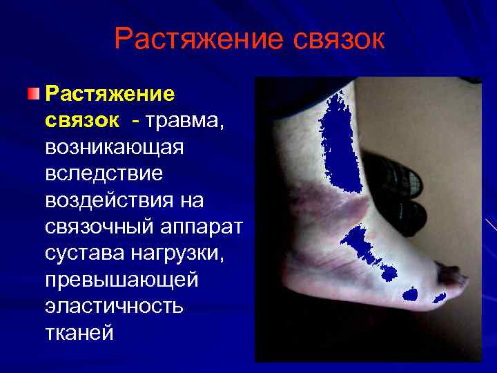 Растяжение связок травма, возникающая вследствие воздействия на связочный аппарат сустава нагрузки, превышающей эластичность тканей