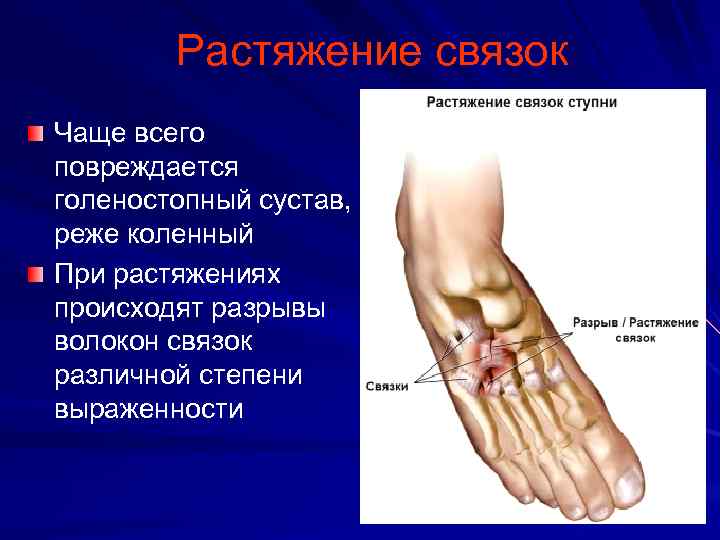 Растяжение связок Чаще всего повреждается голеностопный сустав, реже коленный При растяжениях происходят разрывы волокон