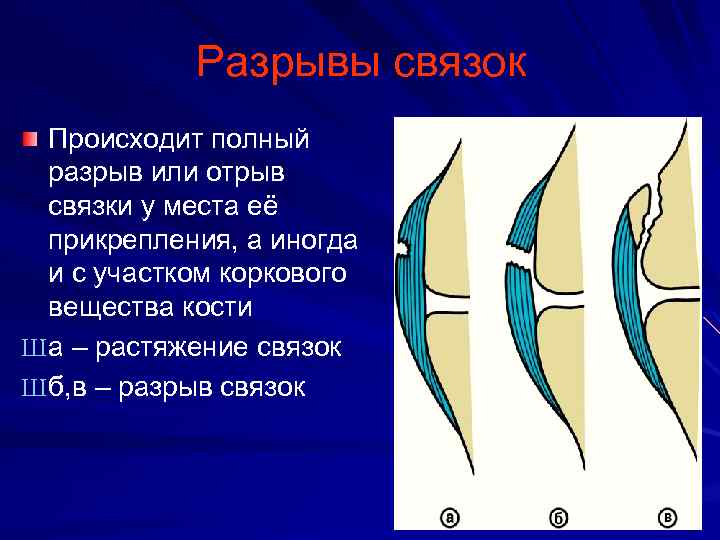 Разрывы связок Происходит полный разрыв или отрыв связки у места её прикрепления, а иногда