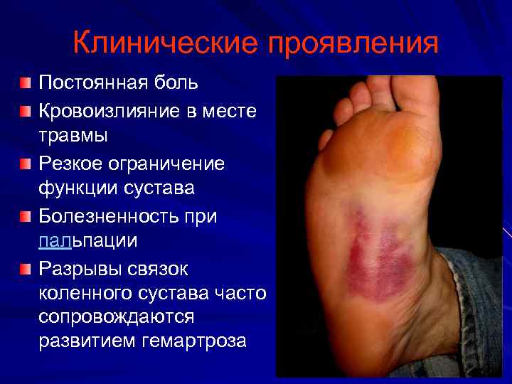 Клинические проявления Постоянная боль Кровоизлияние в месте травмы Резкое ограничение функции сустава Болезненность при