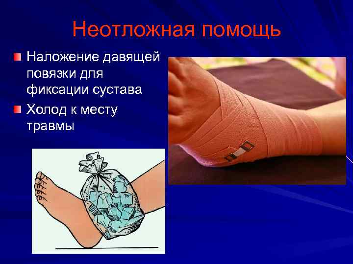 Неотложная помощь Наложение давящей повязки для фиксации сустава Холод к месту травмы 
