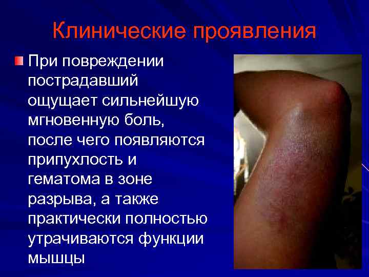 Клинические проявления При повреждении пострадавший ощущает сильнейшую мгновенную боль, после чего появляются припухлость и
