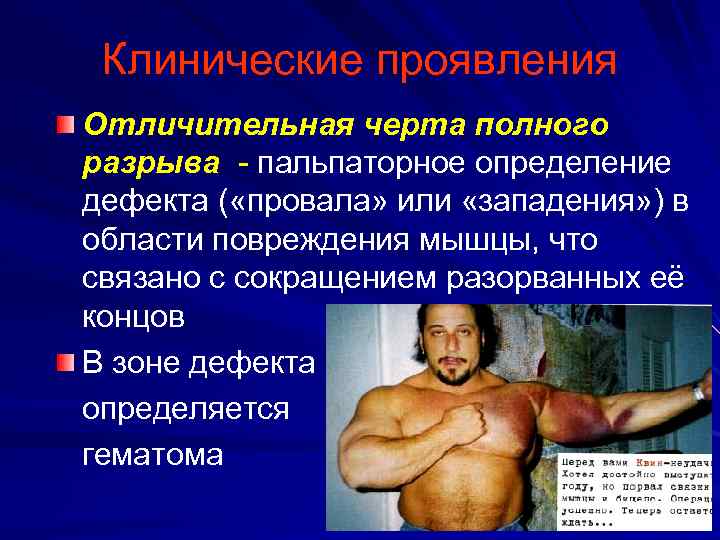 Клинические проявления Отличительная черта полного разрыва пальпаторное определение дефекта ( «провала» или «западения» )