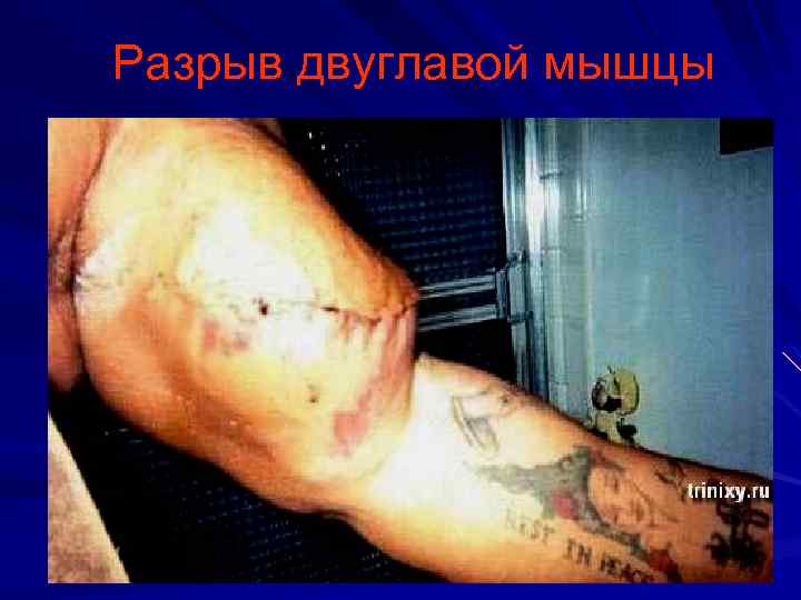 Разрыв двуглавой мышцы 