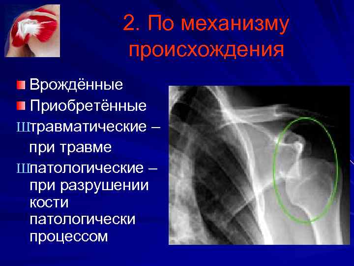 2. По механизму происхождения Врождённые Приобретённые Штравматические – при травме Шпатологические – при разрушении