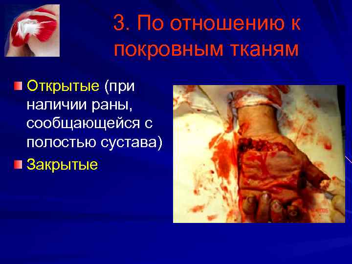 3. По отношению к покровным тканям Открытые (при наличии раны, сообщающейся с полостью сустава)