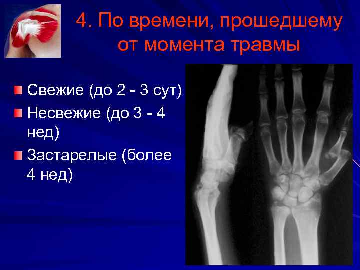 4. По времени, прошедшему от момента травмы Свежие (до 2 3 сут) Несвежие (до