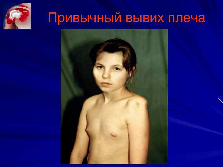 Привычный вывих плеча 