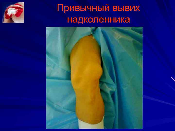 Привычный вывих надколенника 
