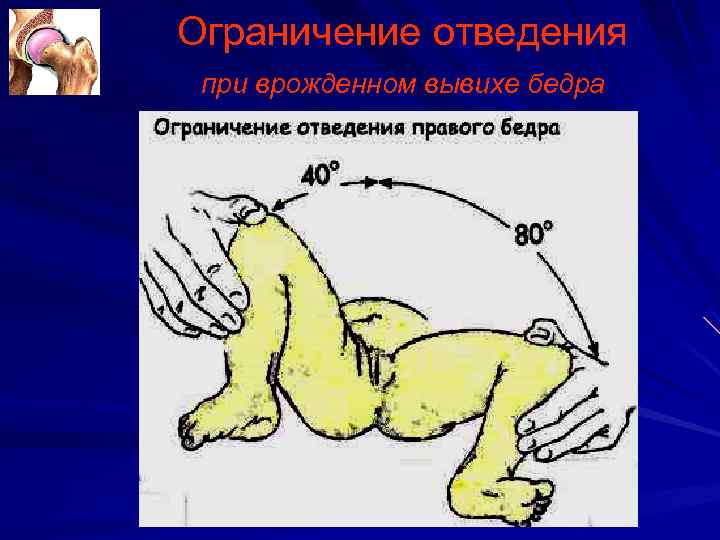 Ограничение в тазобедренном суставе. Врожденный вывих бедра ограничение отведения. Симптом ограничения отведения бедра.