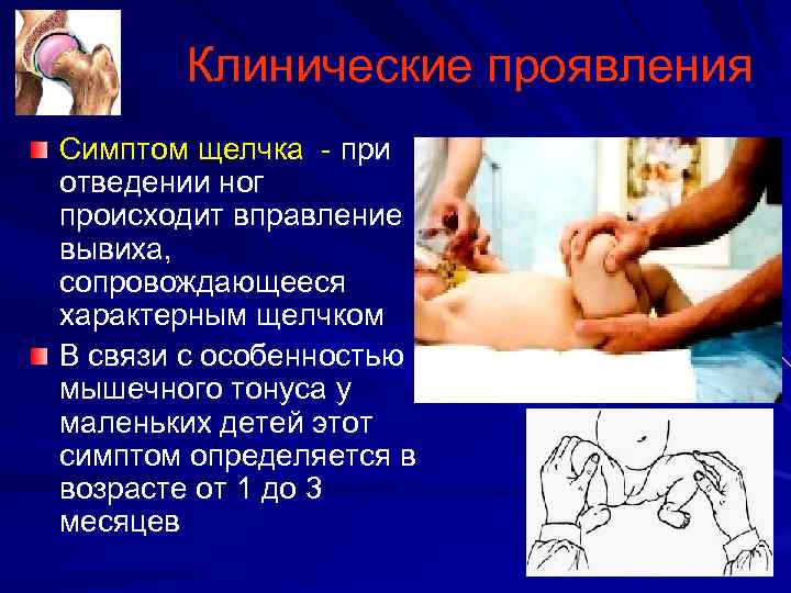 Клинические проявления Симптом щелчка при отведении ног происходит вправление вывиха, сопровождающееся характерным щелчком В