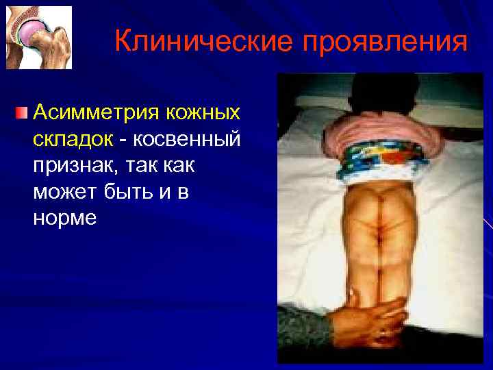 Клинические проявления Асимметрия кожных складок косвенный признак, так как может быть и в норме