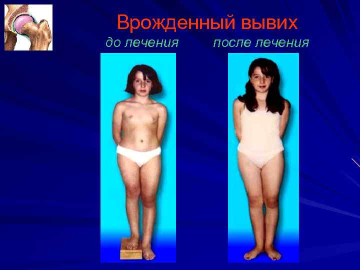 Врожденный вывих до лечения после лечения 