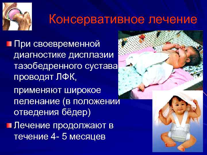 Консервативное лечение При своевременной диагностике дисплазии тазобедренного сустава проводят ЛФК, применяют широкое пеленание (в