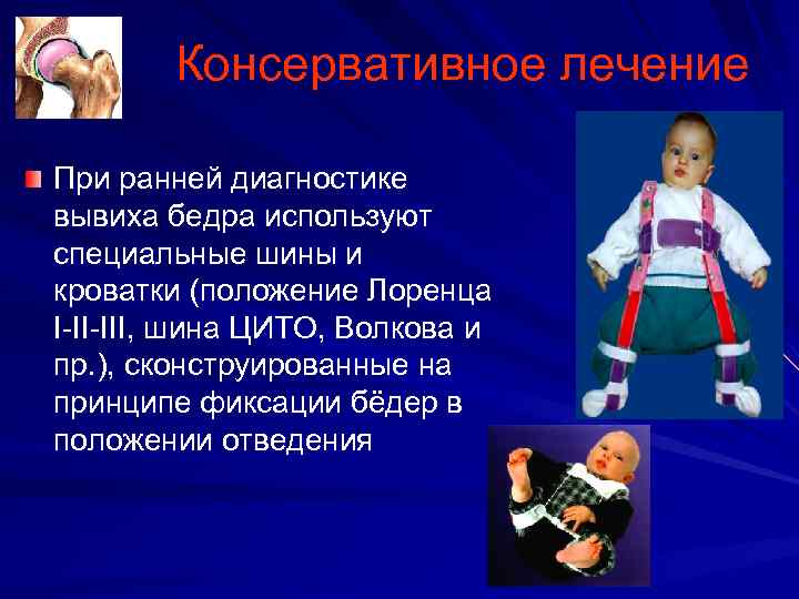Консервативное лечение При ранней диагностике вывиха бедра используют специальные шины и кроватки (положение Лоренца