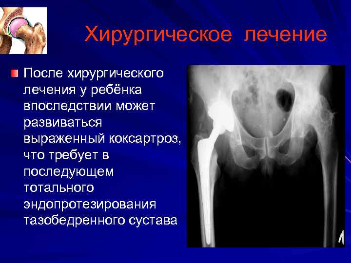 Хирургическое лечение После хирургического лечения у ребёнка впоследствии может развиваться выраженный коксартроз, что требует