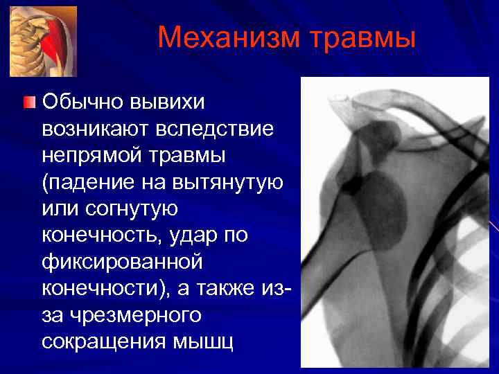Механизм травмы Обычно вывихи возникают вследствие непрямой травмы (падение на вытянутую или согнутую конечность,