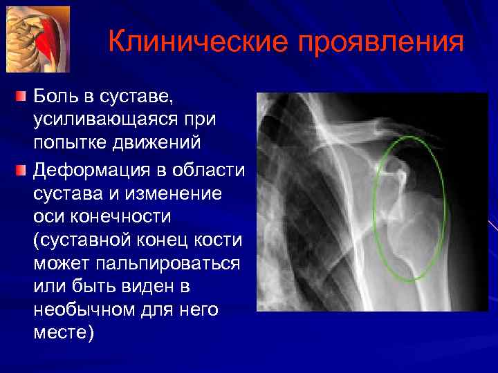 Клинические проявления Боль в суставе, усиливающаяся при попытке движений Деформация в области сустава и