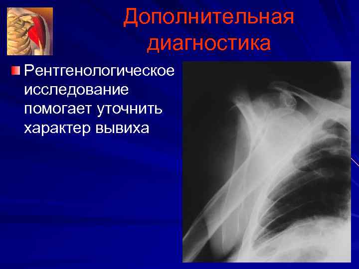 Дополнительная диагностика Рентгенологическое исследование помогает уточнить характер вывиха 