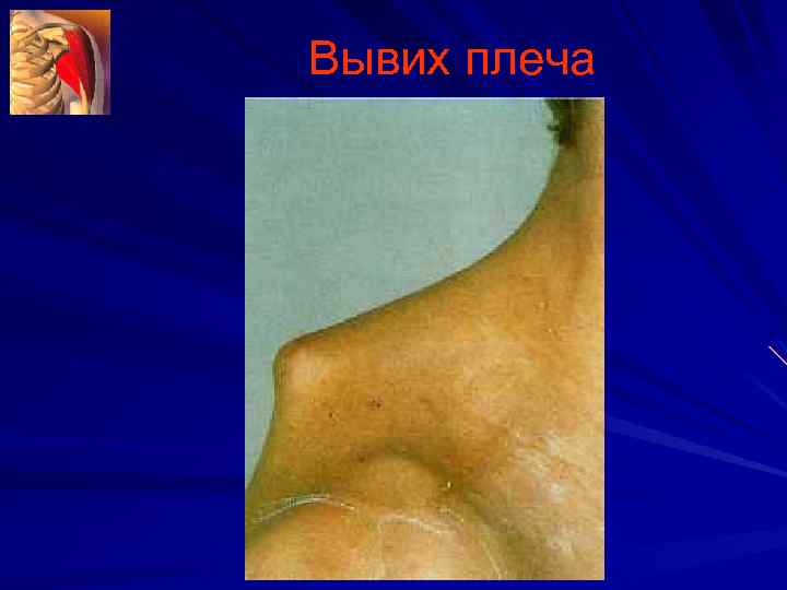 Вывих плеча 