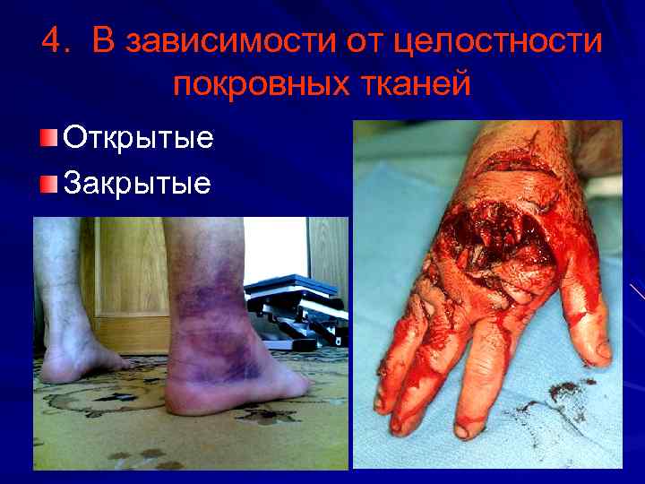4. В зависимости от целостности покровных тканей Открытые Закрытые 