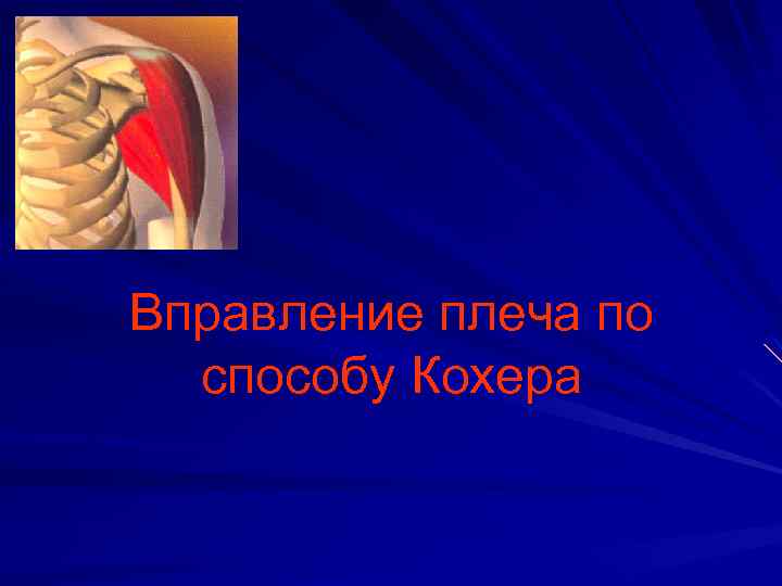 Вправление плеча по способу Кохера 