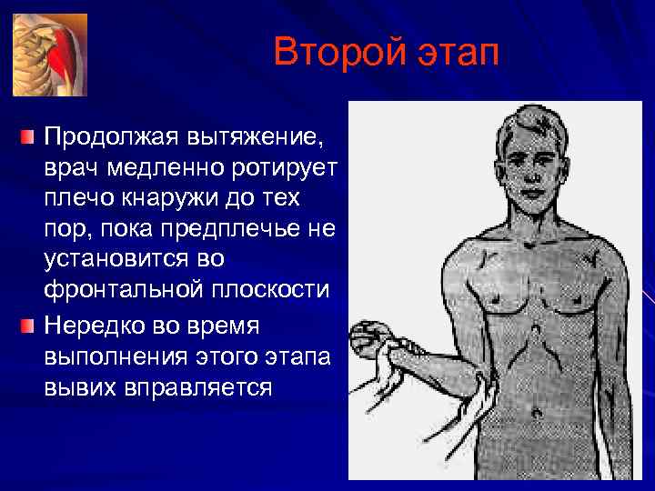 Второй этап Продолжая вытяжение, врач медленно ротирует плечо кнаружи до тех пор, пока предплечье