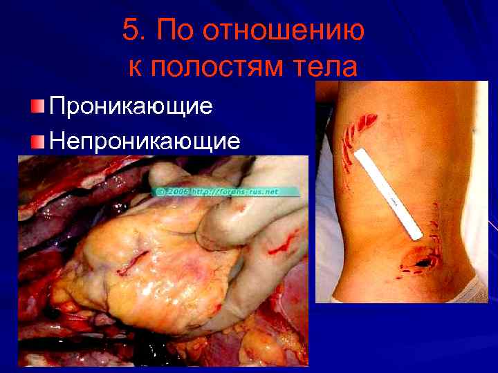 5. По отношению к полостям тела Проникающие Непроникающие 