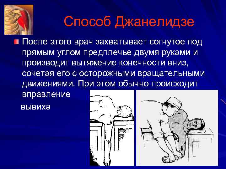 Способ Джанелидзе После этого врач захватывает согнутое под прямым углом предплечье двумя руками и
