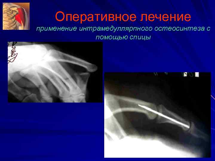 Оперативное лечение применение интрамедуллярпного остеосинтеза с помощью спицы 