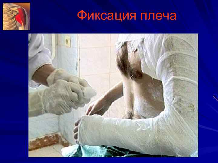 Фиксация плеча 