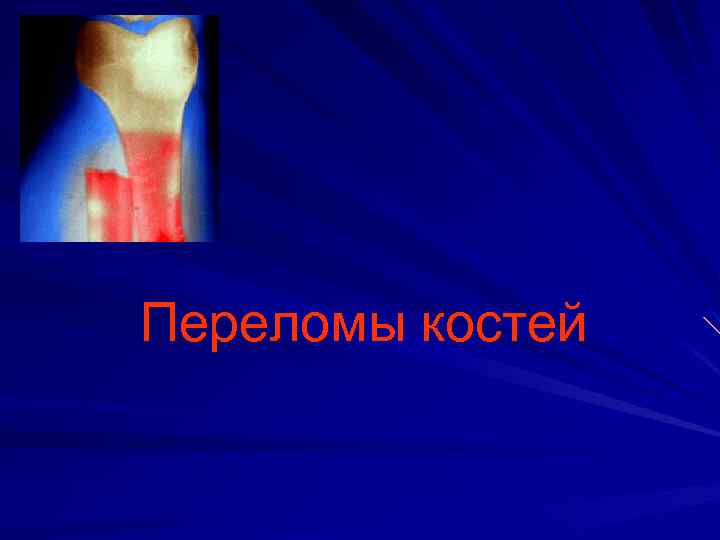 Переломы костей 