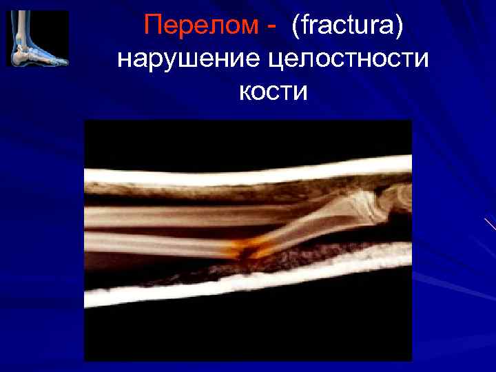 Перелом (fractura) нарушение целостности кости 