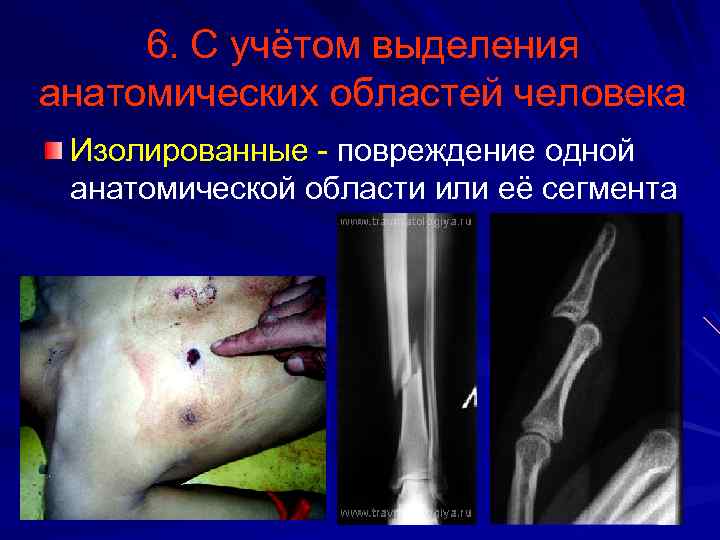 6. С учётом выделения анатомических областей человека Изолированные повреждение одной анатомической области или её