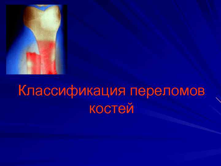 Классификация переломов костей 