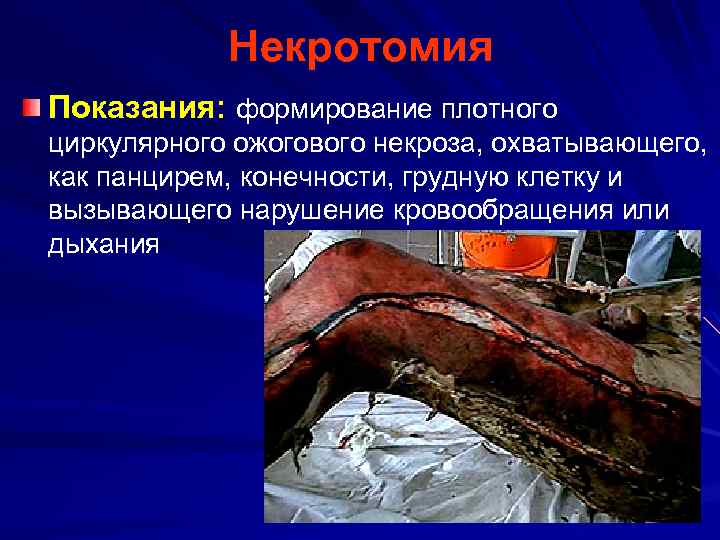 Некротомия Показания: формирование плотного циркулярного ожогового некроза, охватывающего, как панцирем, конечности, грудную клетку и
