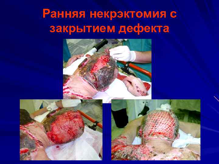 Ранняя некрэктомия с закрытием дефекта 