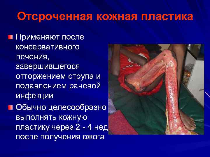 Отсроченная кожная пластика Применяют после консервативного лечения, завершившегося отторжением струпа и подавлением раневой инфекции