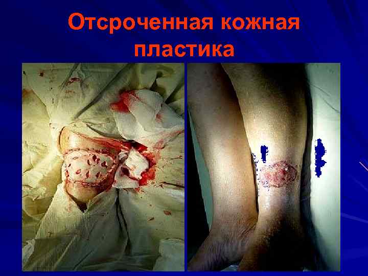 Отсроченная кожная пластика 