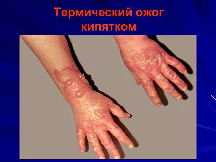 Термический ожог кипятком 