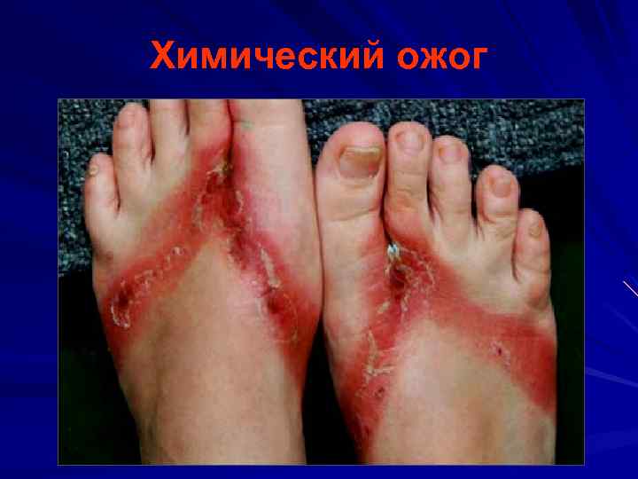 Химический ожог 